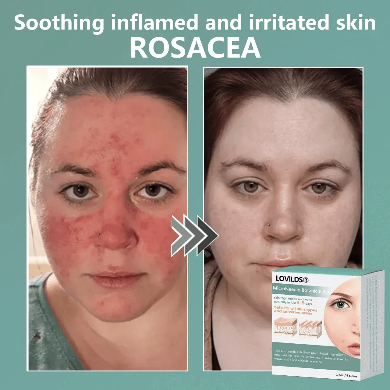 š„Final 3 Hours - Magnesium MicroNeedle Quick Remove Skin Tag Patches