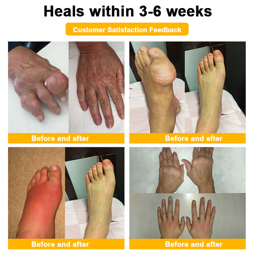 🎁Flash Sale - ODALIT™ Botulinum Toxin & Bee Venom Pain-Relief Bone Healing Cream🐝💎
